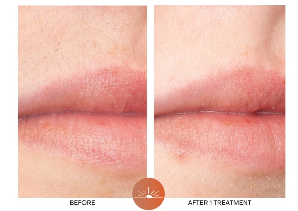Laser Hair Removal before and After for upper lips