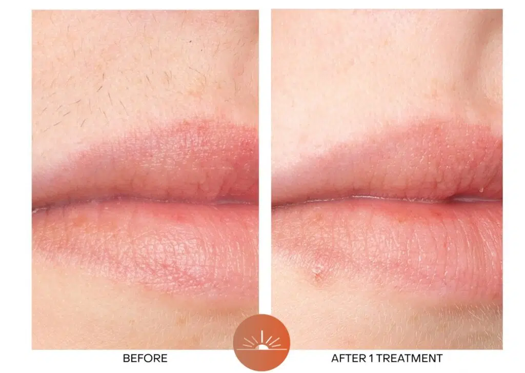 Laser Hair Removal before and After for upper lips