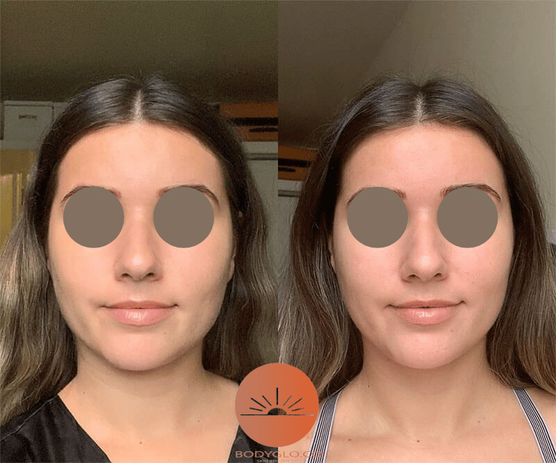 Red Light Therapy Before and After2