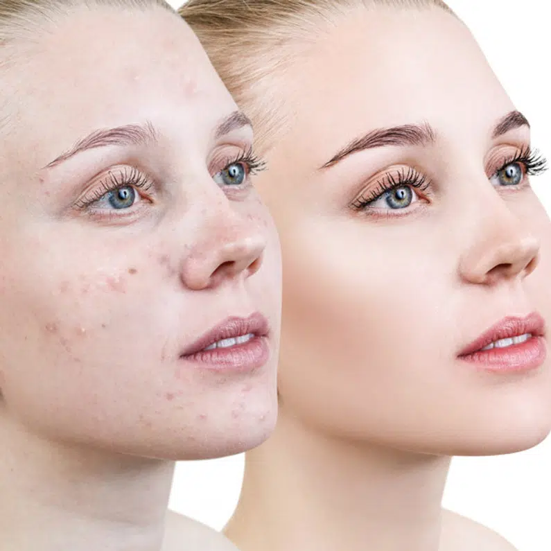 Acne Scars