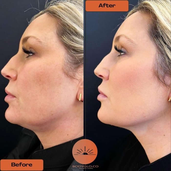 double chin removal Mississauga