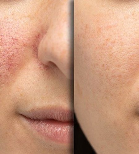photofacial before and after results in Mississauga